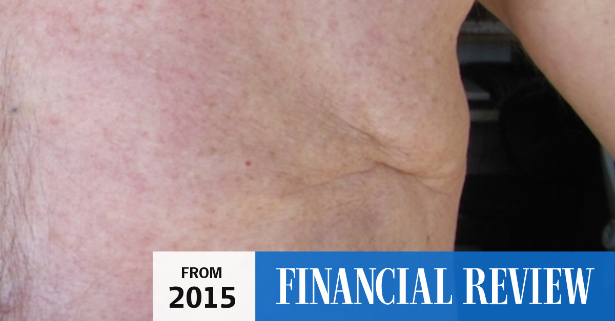 Signs and symptoms of male breast cancer